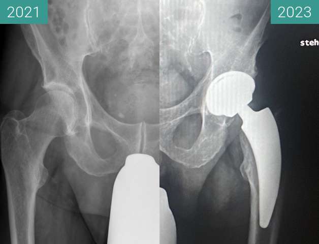 Before-and-after picture of Hüft-OP, die Zweite between 2021-Feb-05 and 2023-Jan-04