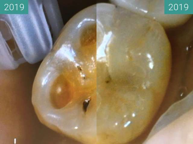 Vorher-Nachher-Bild von beim Zahnarzt zwischen 27.02.2019 und 27.02.2019